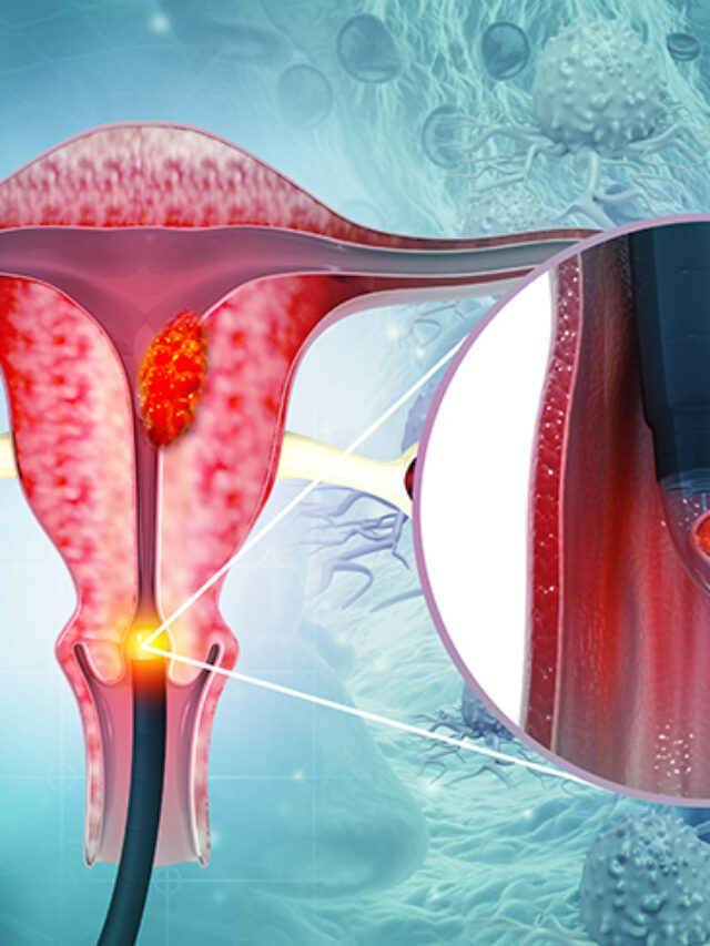 Read more about the article Cervical cancer signs and symptoms